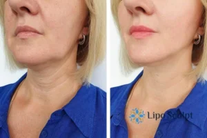 Double chin before and after Hi-Fu treatment 4 Book your double chin treatment Bordesley today! We are here to help!