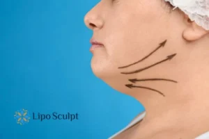 Double chin before and after Hi-Fu treatment 3 Boost your confidence with a Double chin treatment Bordesley
