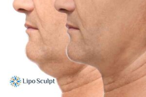 Double chin before and after Hi-Fu treatment 2 Double chin treatment Bordesley from Lipo Sculpt - feel more confident today!