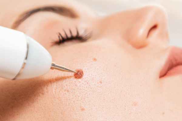 CryoPen: 5 Skin Concerns It May Be Used to Treat 3 What actually happens during a CryoPen treatment Bordesley?