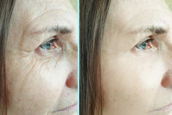 Why Do People Choose HIFU for a Non-Surgical Facelift? 4 How long can HIFU results last Bordesley?
