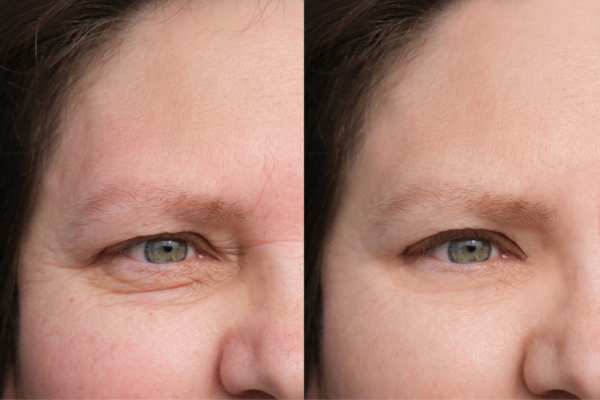 HIFU vs Botulinum Toxin: Understanding the Differences 4 How long do HIFU results last Bordesley?