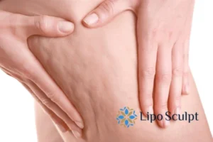 CoolSculpting for Legs: The Innovative Approach to Redefining Your Legs 5 Start your journey today book your coolsculpting treatment Bordesley online today!