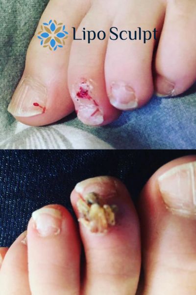 Wart removal customer results from Lipo Sculpt Bordesley